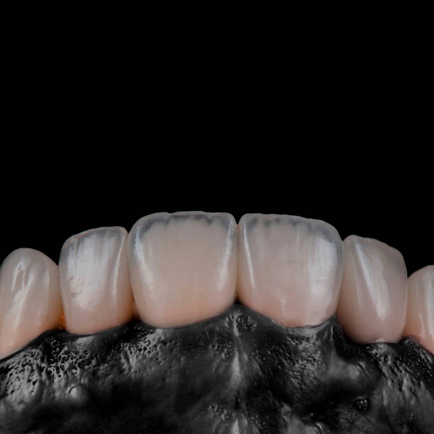 Laboratorio especialista en carillas estéticas en Alicante