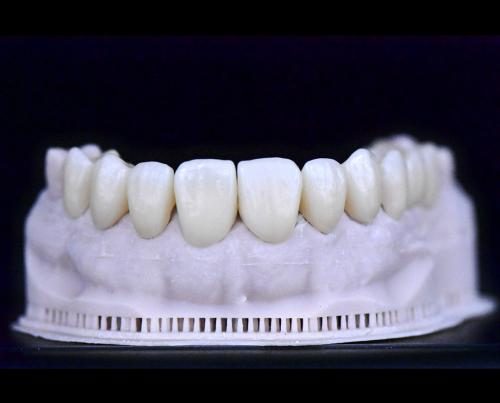 Expertos en Coronas sobre Implantes