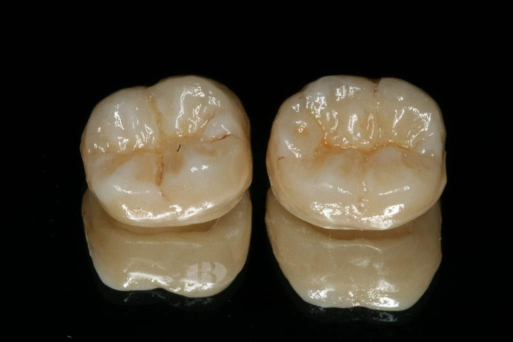 Laboratorio Dental Especializado en Zirconio en Alicante