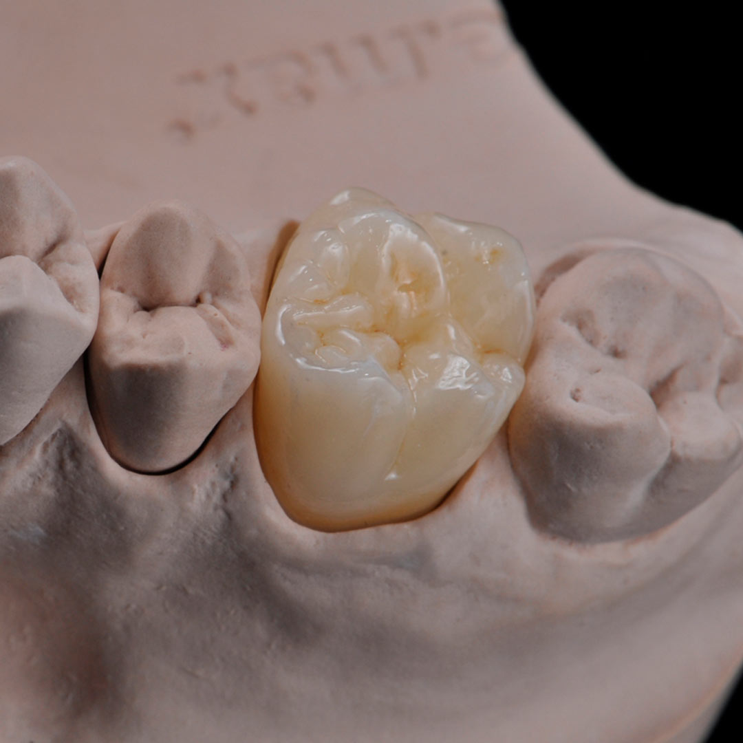 Zirconio monolítico vs zirconio multilayer