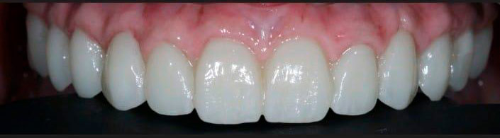 Encía cerámica en rehabilitación de pacientes edéntulos