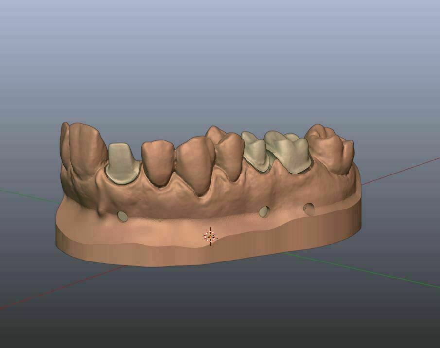 Cómo un laboratorio dental CAD-CAM reduce errores clínicos y mejora la predictibilidad de los tratamientos